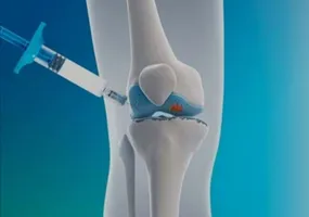 Viscossuplementação de Joelho