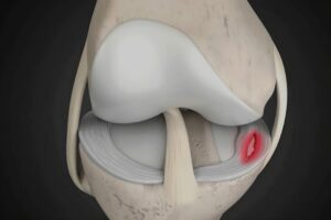 Lesões Meniscais CEO Centro de Ortopedia