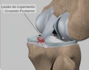 Reconstrução do ligamento cruzado posteriorLCP CEO Centro de Ortopedia