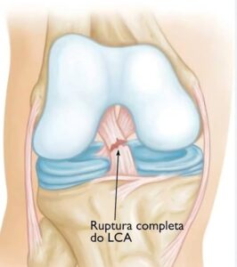 Reconstrução para lesão do ligamento cruzado anteriorLCA CEO Centro de Ortopedia