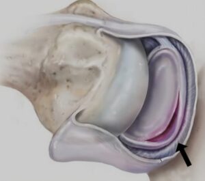 Reparo de Lesões do Labrum CEO Centro de Ortopedia