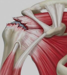 Reparo de lesões do Manguito Rotador CEO Centro de Ortopedia