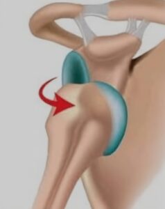 Tratamento para Luxação Recidivante Glenoumeral CEO Centro de Ortopedia