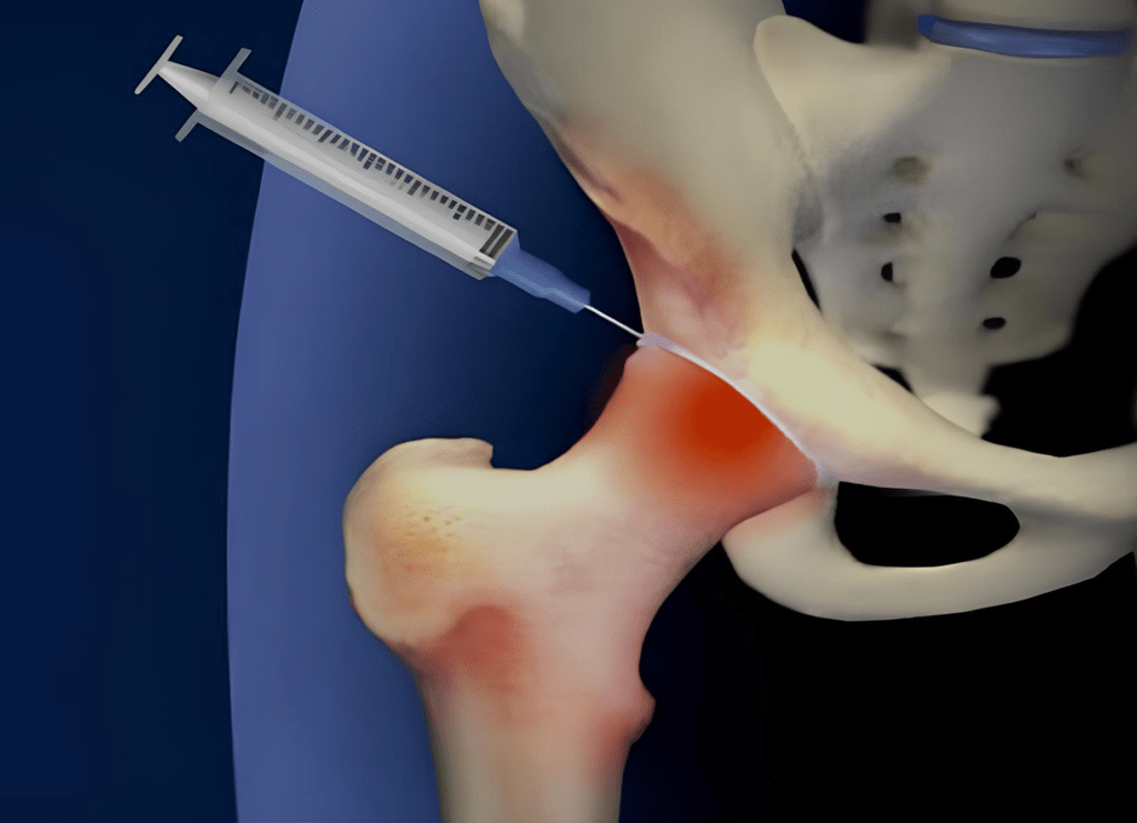 viscossuplementacao de quadril 1 CEO Centro de Ortopedia CEO Centro de Ortopedia