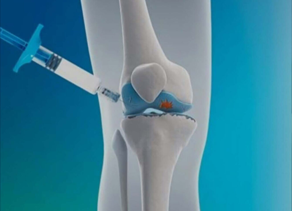 viscossuplementacaodojoelho1transformed CEO Centro de Ortopedia CEO Centro de Ortopedia